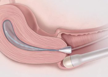 Siêu âm dò âm đạo là phương pháp siêu âm vùng chậu tốt nhất 