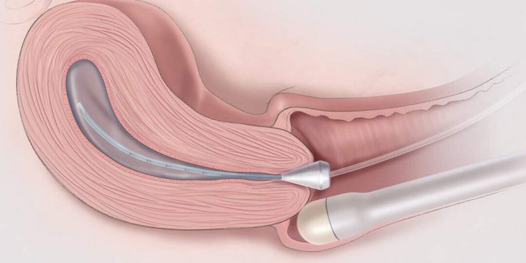 Siêu âm dò âm đạo là phương pháp siêu âm vùng chậu tốt nhất
